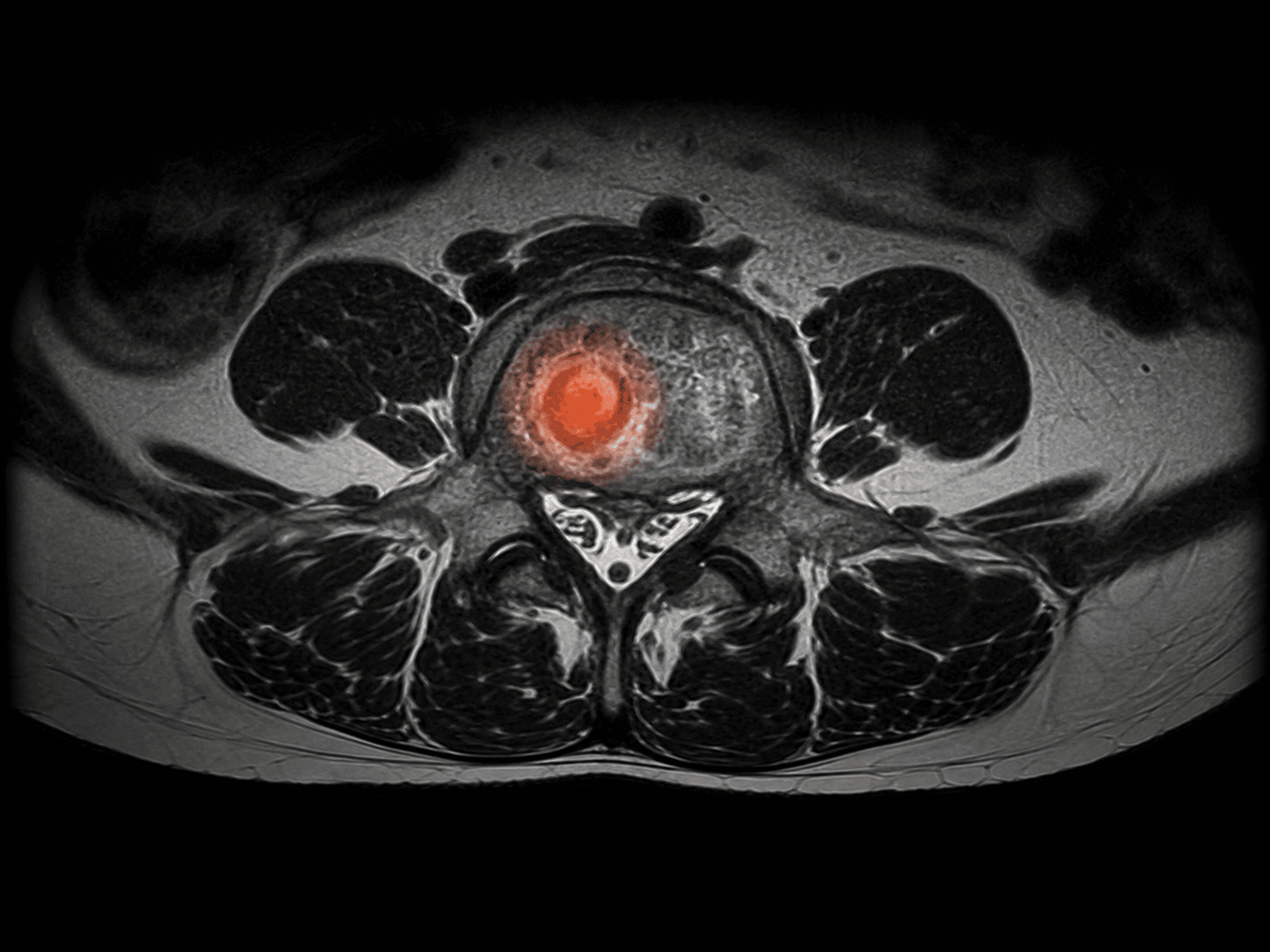 Imagen médica de infecciones de columna