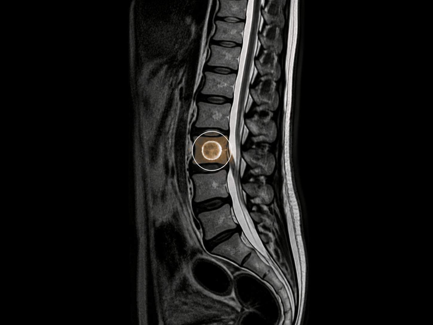 Imagen médica de tumores vertebrales